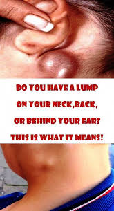 Do You Have A Lump On Your Neck Back Or Behind Your Ear This Is What It Means Dryskinlump Skin Bumps Itchy Skin Ear