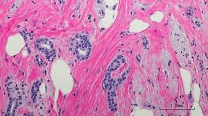 The pancreas is an organ that releases enzymes involved with digestion, and hormones to regular blood sugar levels. Test Predicts Chance Of Living More Than A Year On Targeted Breast Cancer Treatment Technology Networks