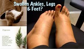 Eucalyptus oil has been marketed for decades as an antibacterial, antifungal, antiviral, antiseptic, and anesthetic substance. Best Eos For Swollen Ankles Legs Feet Essential Oil Treatments Cypress Essential Oil Best Essential Oils