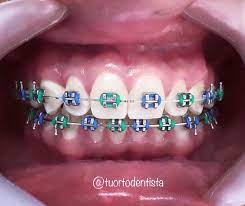 Pin En Ortodoncia