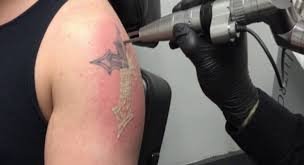 Those that act as a lightening agent and those that peel. What Does Tattoo Removal Do To Your Skin Fresh Skin Canvas