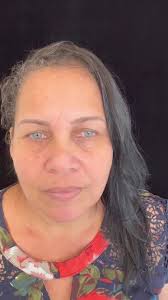 Blefaroplastia superior . Dra Priscilla Barros CRO: 13633 Dr Jonatha...