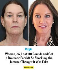 🔗: bit.ly/4l4XHJN Tina Heaton decided in 2021 that she was ready for a  lifestyle shift. 📷️: Nayak Plastic Surgery