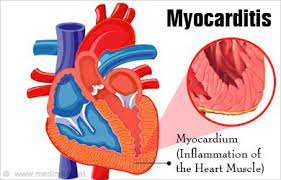 Studies with experimental transmission of heart and skeletal muscle inflammation in atlantic salmon, salmo salar l. Pin By Nonas Arc On Myocarditis Inflammation Of The Heart Rare Disorders Heart Muscle