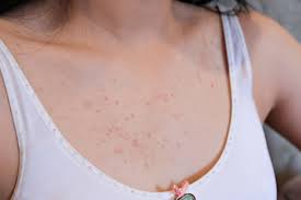 Your doctor can also prescribe creams with a higher concentration of urea. Sweat Pimples Causes Treatment And Prevention