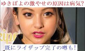 Risel 岸野良平(きっしー)ヘアアレンジ シールエクステ on instagram: ããã½ãã®æ¿ããã®åå ã¯çæ° æ¢ã«ã©ã¤ã¶ããå®æ½ãã¦ã