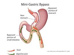 Mini Gastric Bypass Surgery Gastric Bypass Surgery Bypass Surgery Gastric Bypass