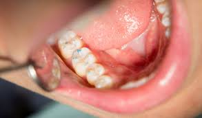 Image result for Occlusal