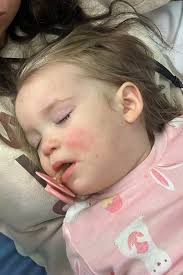 Berkley starts physical therapy journey