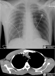Poland syndrome is a rare condition that is evident at birth (congenital). Learningradiology Poland Syndrome
