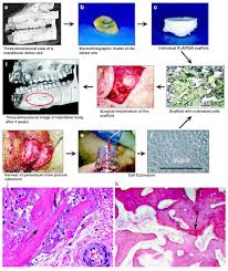 Three Dimensional Printing With Biomaterials In Craniofacial