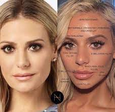 Pinterest Seanabeauty Cheek Fillers Face Fillers Facial Surgery