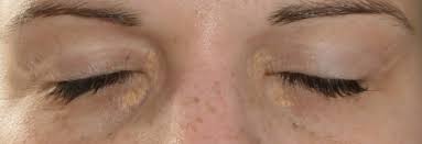 Image result for xantelasma