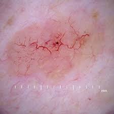 Skin cancer is the most common type of cancer in the united states by a pretty large margin, and it does not discriminate. Basal Cell Carcinoma Wikipedia
