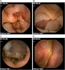 Some people with cancer feel as if they need to have a bowel movement and still feel that way after. Capsule Endoscopy In The Evaluation Of Small Bowel Tumors And Polyps Sciencedirect
