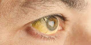 Check spelling or type a new query. Penyebab Mata Kuning Yang Perlu Diwaspadai Kenali Cara Untuk Mengobatinya Merdeka Com