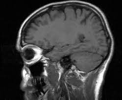 性的映像、脳にダメージ与え「ポル脳」に 脳が収縮し中毒化、ゾンビ状態へ (2015年11月5日) - エキサイトニュース