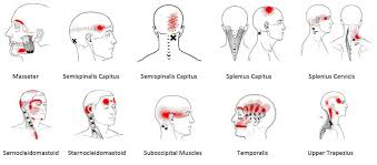 Headaches Archives Baltimore Md Physical Therapy For Sports And Injury Rehab