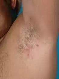 I Have A Lump In My Armpit Should I Be Worried Quora