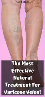 Pin On Varicose Veins