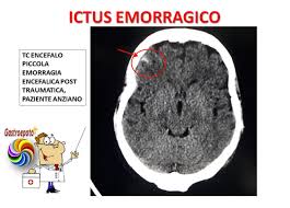 L'emorragia cerebrale può essere causata da un aneurisma, o qualsiasi altra anomalia dei vasi sanguigni. Ictus Emorragico
