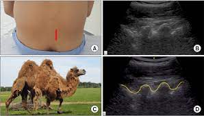 However, those beliefs are a myth that was a hump is a camel's energy storage. A Camel Hump Sign Of The Lumbar Articular Process In A Lumbar Download Scientific Diagram