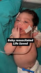 Image result for Vacuum Caput