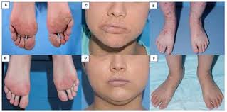 Wiskott-Aldrich Syndrome (WAS) and Dedicator of Cytokinesis 8- (DOCK8)  Deficiency