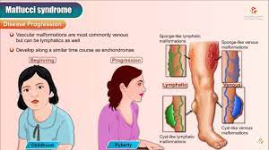 Maffucci S Syndrome Animation Youtube