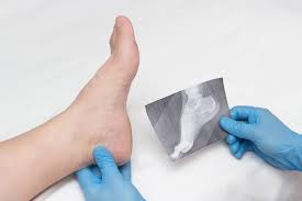 Bone spurs, or osteophytes, are small, bony growths that occur near damaged joints. Bone Spur Types Treatment Options Arizona Foot Doctors