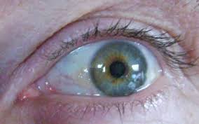 Weiss Gelber Fleck Im Auge Pinguecula Was Ist Das Visus Contactlinsen