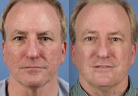 Image result for Laser Skin Procedure