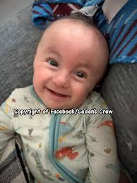 Introduction and photo of trisomy 18 baby