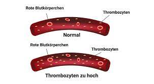 Thrombozytose Zu Viele Blutplattchen Praktischarzt