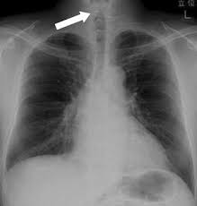 Pulmonary embolism resulting in an infarcted area. Figure 1 Steeple Sign And Narrowed Upper Airway In An Influenza Patient Springerlink