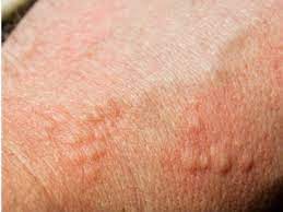 According to the american cancer society, just over 100,000 new cases of skin cancer are diagnosed in the united states each year. à®‡à®ª à®ªà®Ÿ à®µà®¨ à®¤ à®…à®¤ à®µ à®® à®'à®° à®µà®• à®ª à®± à®± à®¨ à®¯ à®¤ à®© à®® à®†à®© à®‰à®¯ à®° à®• à®• à®ªà®¯à®ª à®ªà®Ÿà®¤ à®¤ à®µ à®¯ à®² à®² Skin Cancer Symptoms Types And Home Remedies Diet Tips Tamil Boldsky