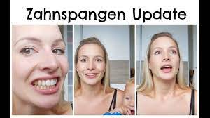 Zahnspangen Update I Lose Spange I Kosten I Annabirdie Youtube