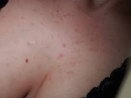 Aids stands for acquired immune deficiency syndrome and is the final stage of the infection caused by the virus called hiv or human immunodeficiency virus. Nach Was Sieht Der Hautaauschlag Fur Euch Aus Gesundheit Und Medizin Hautausschlag Hiv Infektion