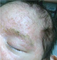 Key points in the history. White Specks In The Hair Visual Diagnosis And Treatment In Pediatrics 3 Ed