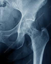 Bone tumors can be of two different types. Secondary Bone Cancer In The Hip X Ray Stock Image C037 1504 Science Photo Library