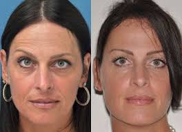 Botox and dysport (the main botox competitor in the us) both last about 3 months and the results can vary in how long they last based on the elasticity of the skin and age of the person treated. Pinterest Face Yoga Face Yoga Before And After Botox