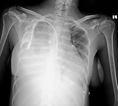 Image result for Hemothorax