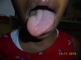 Bei schweren krankheitsverläufen kann die gabe von kortison sinnvoll sein. Glandular Fever Epstein Barr Virus And Hypoglossal Nerve Palsy Archives Of Disease In Childhood