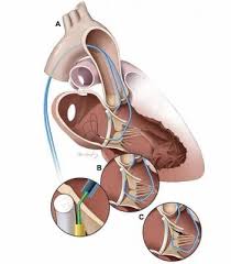 Image result for Left Ventricular Outflow Obstruction