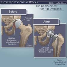 Pin On Hip Replacement Surgery