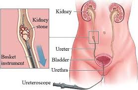 Ureteroscopy Is A Safe And Insignificantly Obtrusive Strategy For Treating Stone Sickness In The Kidney An Kidney Stones Medical Therapy Kidney Stones Symptoms
