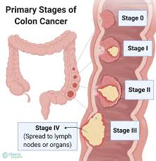 Let the screening warn you. Folfox Chemotherapy For Colon Cancer Chemoexperts