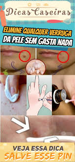 Elimine Qualquer Verruga Da Pele Sem Gasta Nada Com Este Remedio Caseiro Facil De Fazer Dicas Caseiras Dicas Caseiras Dicas Verrugas