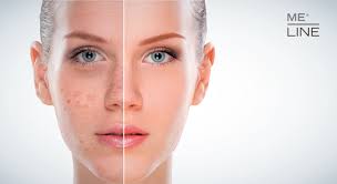 Image result for Diffuse Hyperpigmentation