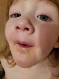 Hi my son is 12 he's autism and afrid, he was diagnosed with a post natural  drip ( the tube you have in your nose to your throat is too narrow) so